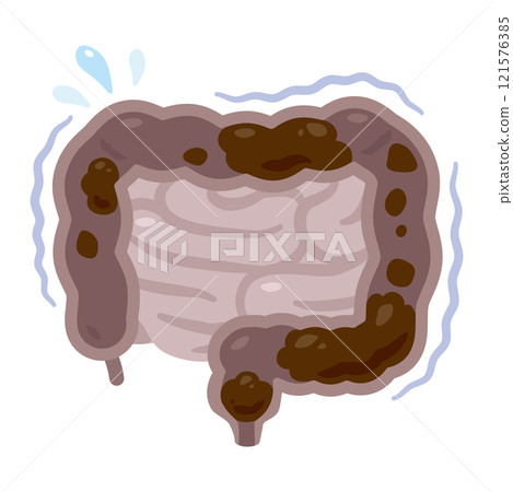 Illustration of a sluggish intestine with stool retention Illustration of a sluggish intestine with stool retention 121576385