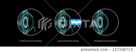 LASIK eye surgery 121586723