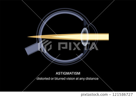 Astigmatism eye disease 121586727