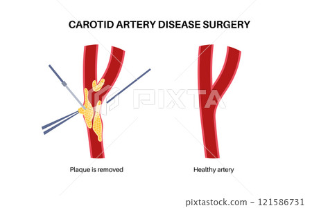 Carotid artery surgery 121586731