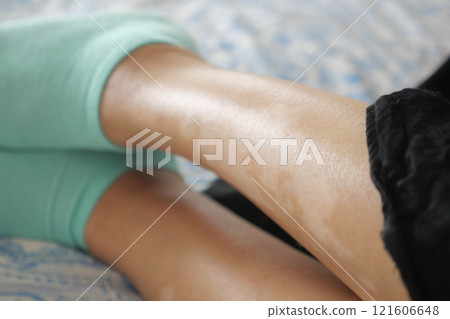 feet with vitiligo skin condition. feet with vitiligo skin condition. 121606648