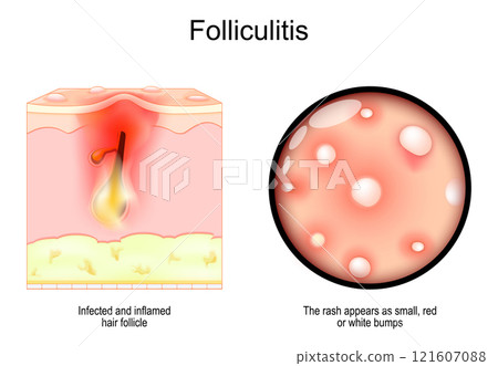 Folliculitis. hair follicle infection and inflammation 121607088