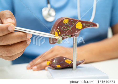 Cirrhosis, Liver cancer, fatty liver, Asian doctor with liver human anatomy model in World Hepatitis Day at hospital. 121610273