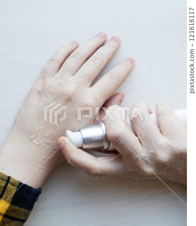 Dry skin on hands. Women's dry hands with peeling, erosions and cracks. Cream for skin dermatological diseases 121616117