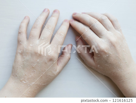 Dry skin on hands. Women's dry hands with peeling, erosions and cracks. Cream for skin dermatological diseases Dry skin on hands. Women's dry hands with peeling, erosions and cracks. Cream for skin dermatological diseases 121616125