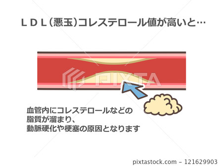 Bad cholesterol and blood vessels Bad cholesterol and blood vessels 121629903