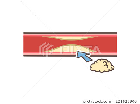 壞膽固醇和血管 121629906