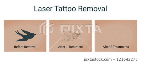 Laser Tattoo Removal Procedure, vector illustration Laser Tattoo Removal Procedure, vector illustration 121642275