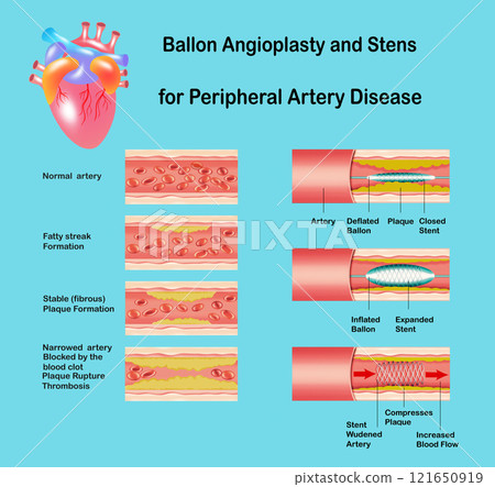Angioplasty. Stent Implantation. Deflated balloon catheter inserted into a coronary artery narrowed by plaque. the balloon is inflated, compressing plaque against the artery wall Angioplasty. Stent Implantation. Deflated balloon catheter inserted into a coronary artery narrowed by plaque. the balloon is inflated, compressing plaque against the artery wall 121650919