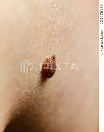 Closeup brown mole on skin. 121676188