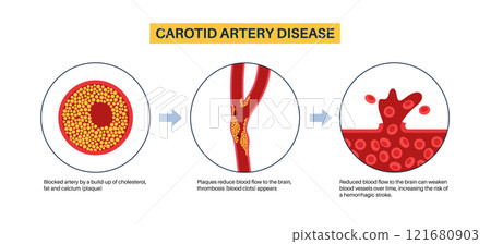 Carotid artery disease 121680903