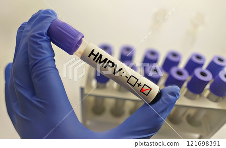 Human Metapneumovirus (HMPV) positive test ,Medical health concept Human Metapneumovirus (HMPV) positive test ,Medical health concept 121698391