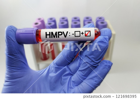 Human Metapneumovirus (HMPV) positive test ,Medical health concept Human Metapneumovirus (HMPV) positive test ,Medical health concept 121698395
