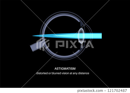 Astigmatism eye disease Astigmatism eye disease 121702487