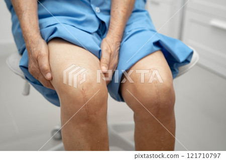 Asian elderly woman patient with scar knee replacement surgery in hospital. Asian elderly woman patient with scar knee replacement surgery in hospital. 121710797