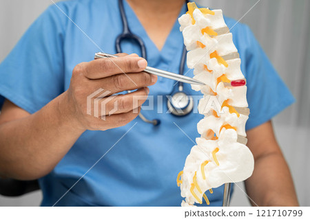 Asian doctor holding spinal nerve and bone model, Lumbar spine displaced herniated disc fragment for treatment medical in the orthopedic department. 121710799