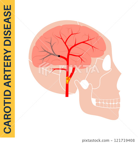 Carotid artery disease Carotid artery disease 121719408