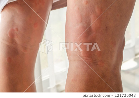 Young asian man has allergic skin rash on his legs from itchy dry skin eczema dermatitis insect bites Young asian man has allergic skin rash on his legs from itchy dry skin eczema dermatitis insect bites 121726048