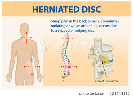 Understanding Herniated Disc Pain 121744312