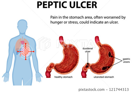 Understanding Peptic Ulcers and Symptoms 121744313