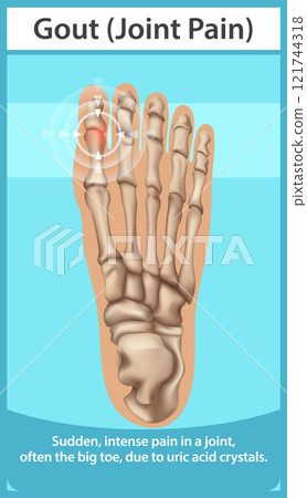 Understanding Gout and Joint Pain 121744318