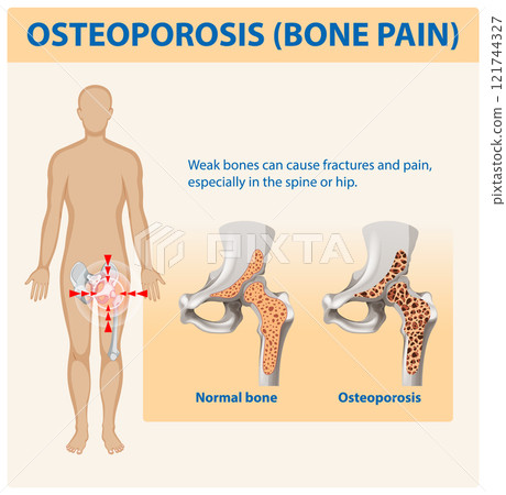 Understanding Osteoporosis and Bone Pain Understanding Osteoporosis and Bone Pain 121744327