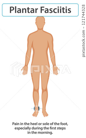 Understanding Plantar Fasciitis Pain Understanding Plantar Fasciitis Pain 121744328