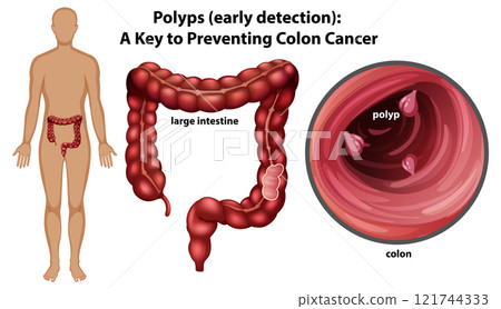 Understanding Colon Polyps and Prevention 121744333