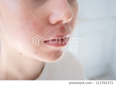 Close up of young woman with acne and post-acne marks on her cheeks. Hormonal acne, puberty and before menstruation, adult acne, rosacea.  121762572