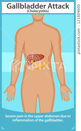 Understanding Gallbladder Attack Symptoms Understanding Gallbladder Attack Symptoms 121804600