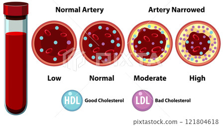 Understanding Artery Health and Cholesterol Levels 121804618