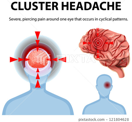 Understanding Cluster Headache Symptoms Understanding Cluster Headache Symptoms 121804628