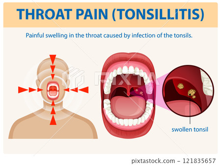 Understanding Throat Pain and Tonsillitis 121835657