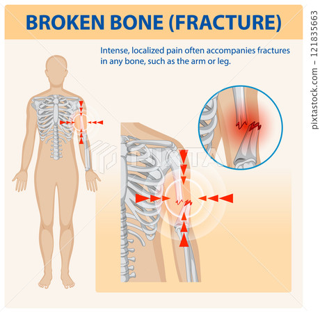 Understanding Bone Fractures and Pain Understanding Bone Fractures and Pain 121835663