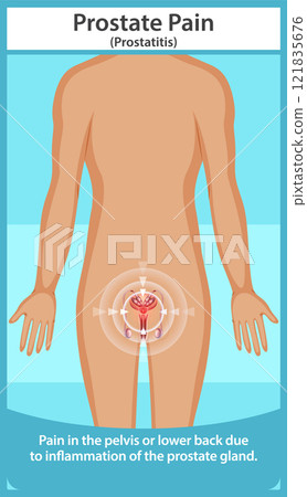 Understanding Prostate Pain and Inflammation Understanding Prostate Pain and Inflammation 121835676