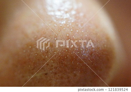 鼻子毛孔被白色角蛋白塞堵塞的特寫 121839524