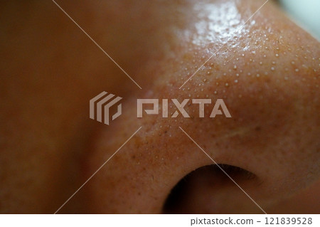 鼻子毛孔被白色角蛋白塞堵塞的特寫 121839528