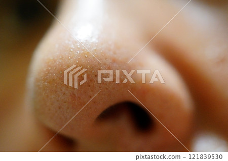 Close-up of nose pores clogged with white keratin plugs Close-up of nose pores clogged with white keratin plugs 121839530