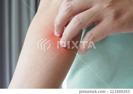 Young asian man itching and scratching on arm from itchy dry skin eczema dermatitis Young asian man itching and scratching on arm from itchy dry skin eczema dermatitis 121880263