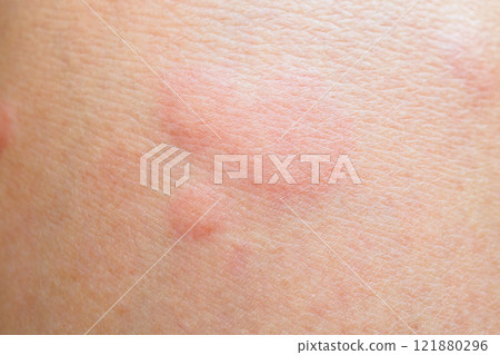 Skin allergy rash dermatitis texture close up background Skin allergy rash dermatitis texture close up background 121880296
