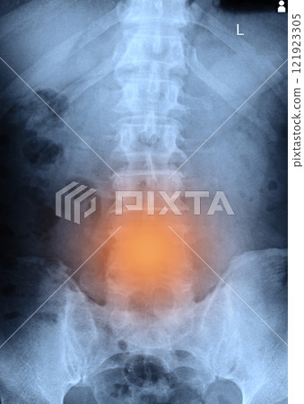 x-ray images lumbar spine x-ray images lumbar spine 121923305