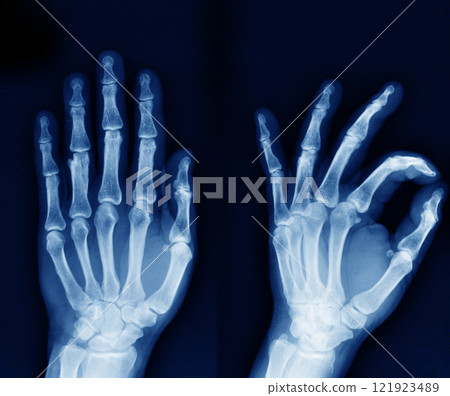 hand x-ray 121923489