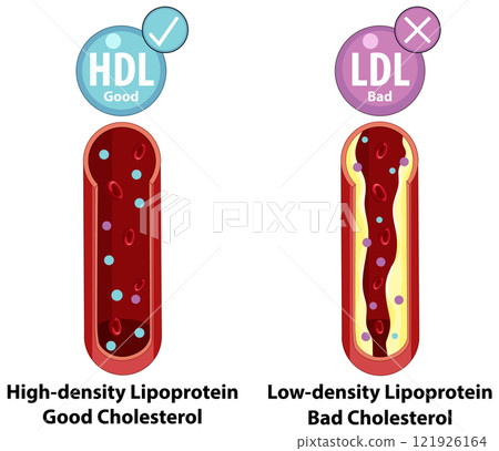 Cholesterol Types: HDL vs LDL Cholesterol Types: HDL vs LDL 121926164