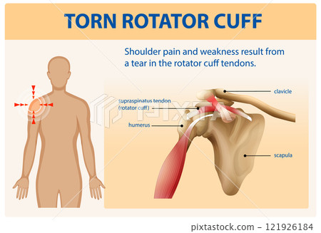 Understanding Torn Rotator Cuff Injuries Understanding Torn Rotator Cuff Injuries 121926184
