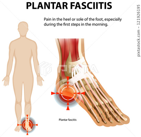 Understanding Plantar Fasciitis Pain Relief Understanding Plantar Fasciitis Pain Relief 121926195