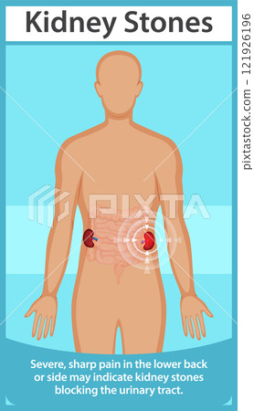 Understanding Kidney Stones and Symptoms Understanding Kidney Stones and Symptoms 121926196
