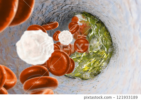Destruction of atheroma plaque inside artery 121933189