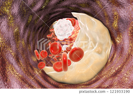 Atheroma plaque inside artery Atheroma plaque inside artery 121933190