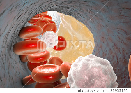 Atheroma plaque inside artery Atheroma plaque inside artery 121933191