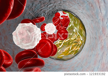 Atheroma plaque inside artery 121933192